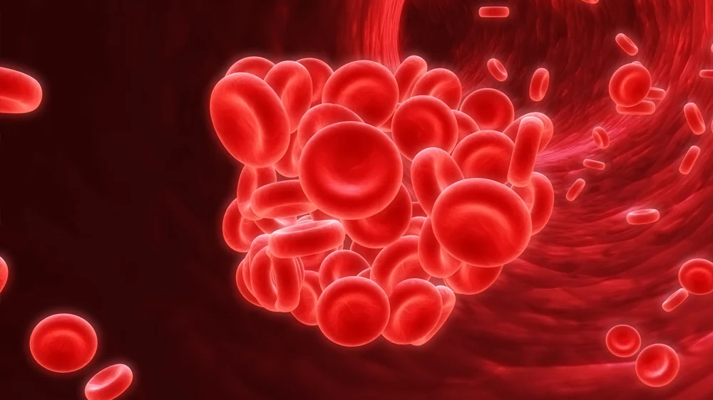 blood clot