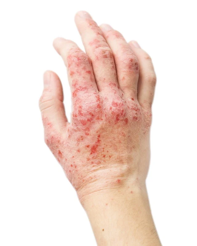 Real photo girl's hand, the patient with eczema before and after treatment