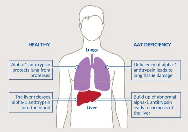 AAT deficiency pic