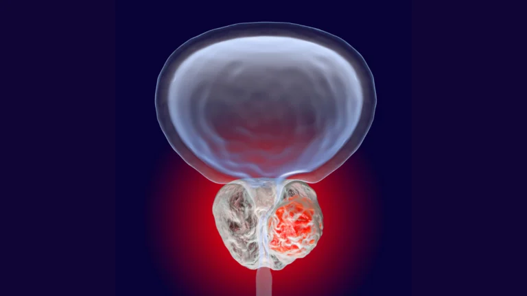 prostate cancer