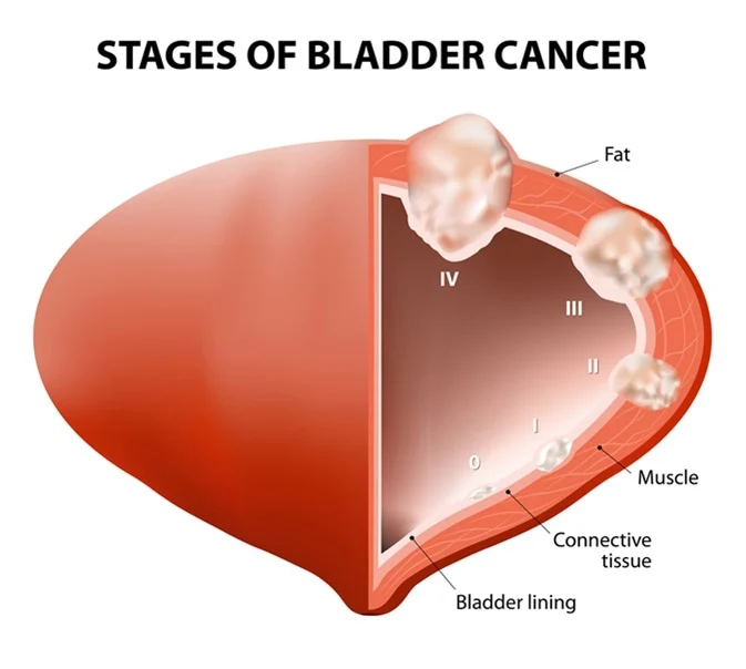 prostate cancer