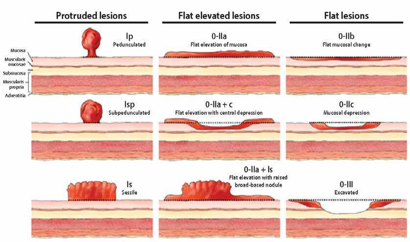 Colonic Polyps Current Understanding Implications Endoscopic Colonic Polyps Current Understanding Implications Endoscopic