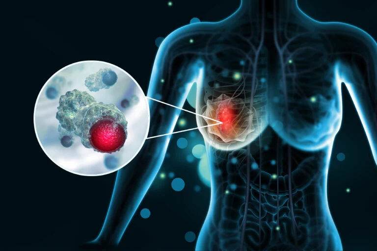Breast cancer, 3D illustration