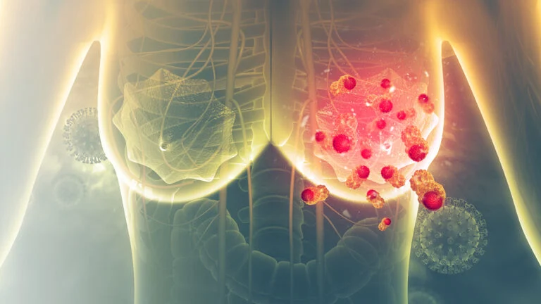 The role of infltrating lymphocytes in the neo‑adjuvant treatment of women with HER2‑positive breast cancer
