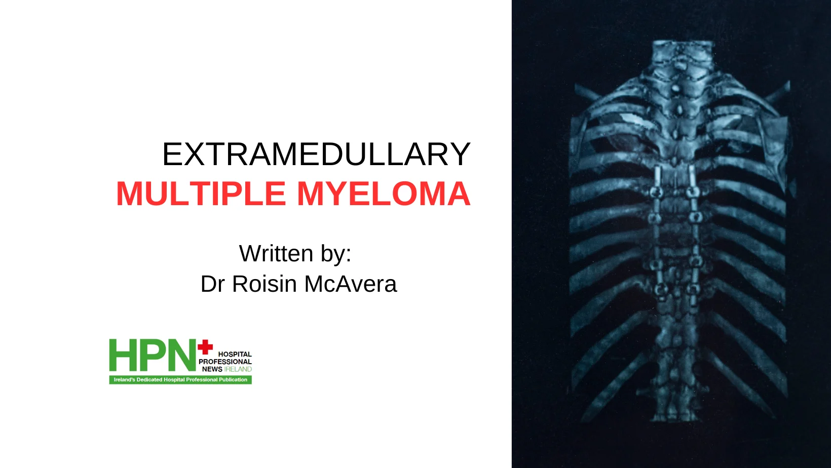 Extramedullary Multiple Myeloma