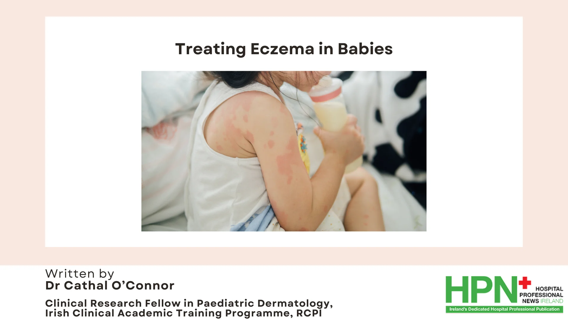 Eczema