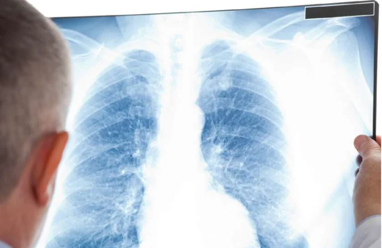EGFR-mutated non-small cell lung cancers: From Molecular Testing to Optimised Targeted Therapy